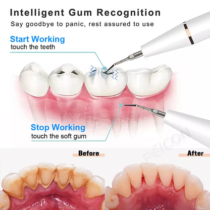 Ultrasonic Electric Dental Cleaner & Calculus Remover